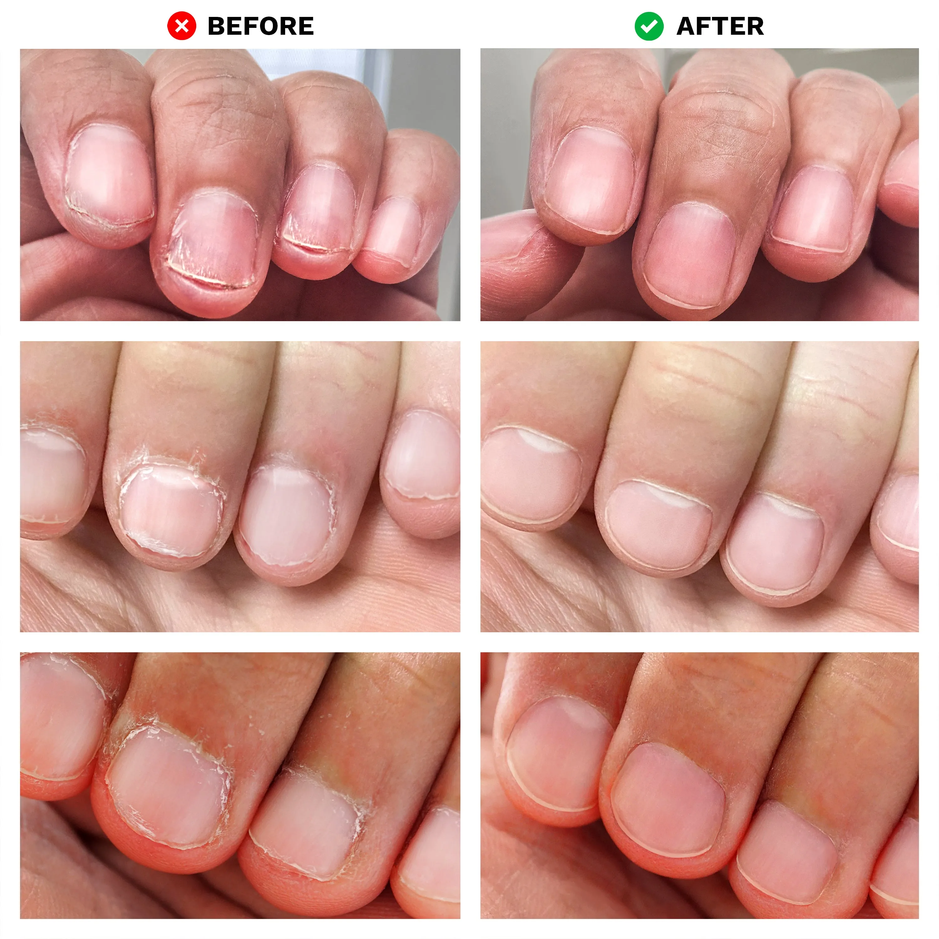 No Bite Nail Recovery | Nail Care